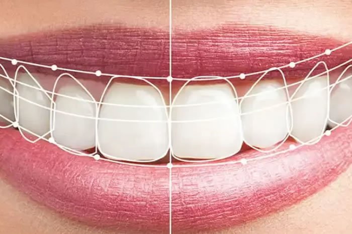 Dijital Gülüş Tasarımı (DSD): Gülüşünüzü Teknolojiyle Yeniden Yaratın